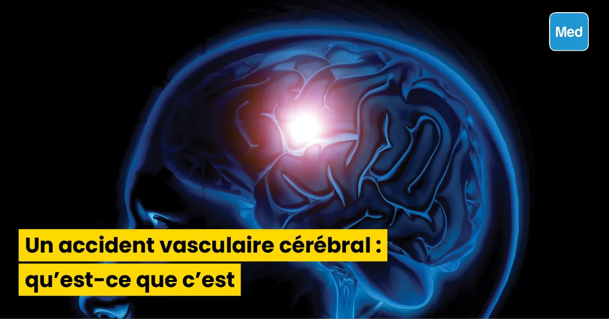 Un accident vasculaire cérébral : qu’est-ce que c’est ?